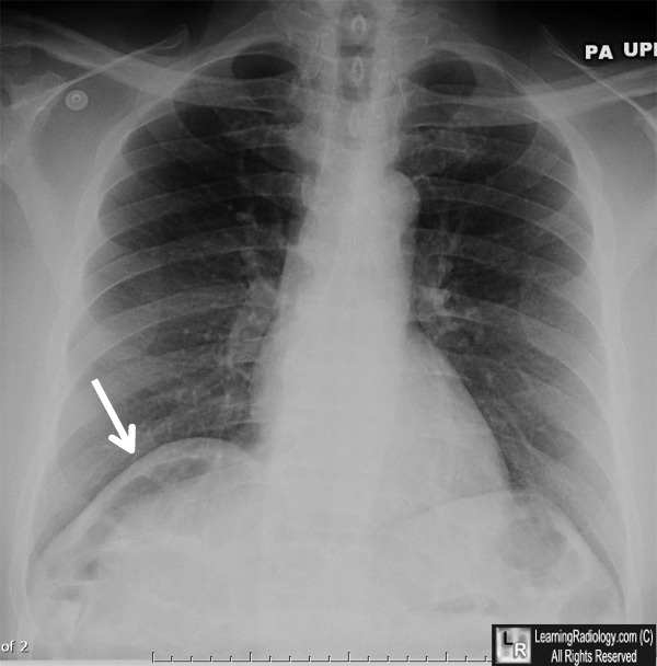 Chilaiditi&rsquo;s Sign Syndrome